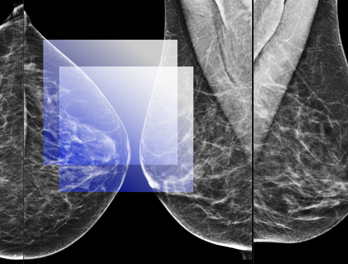 Основи рентгенівської мамографії