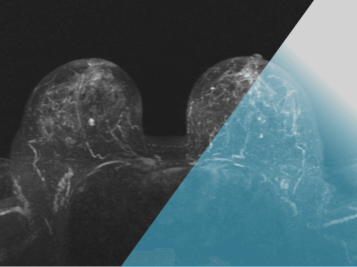 Breast MRI: from basic to advanced