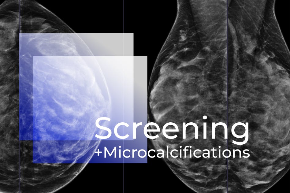 Breast Cancer Screening + Microcalcifications