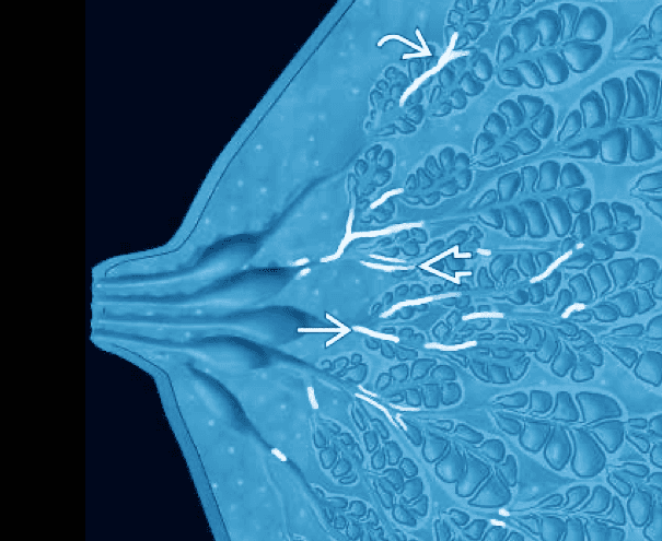 Microcalcifications