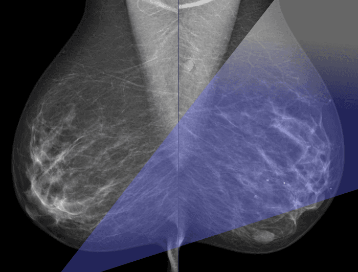 Ранняя диагностика рака молочной железы