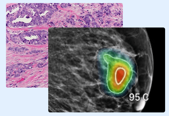 AI - Assisted Mammogram Interpretation