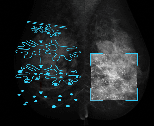 Как упорядочить хаос? Микрокальцинаты