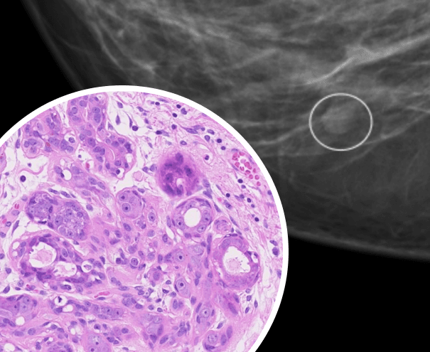 Патоморфология опухолей молочной железы. Базовый курс для маммологов